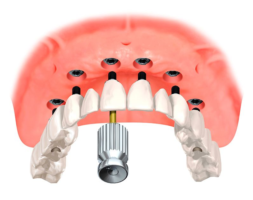 схема крепления импланта к челюсти